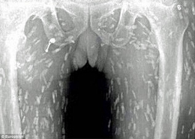 The Chinese man had seen his doctor complaining of stomach ache and itchy skin. Scans revealed his entire body had been infected with tapeworm parasites after eating too much sashimi - raw slices of fish
